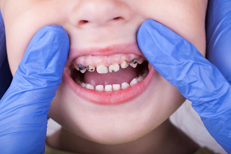 Дырки на зубах у ребенка: причины, лечение, профилактика